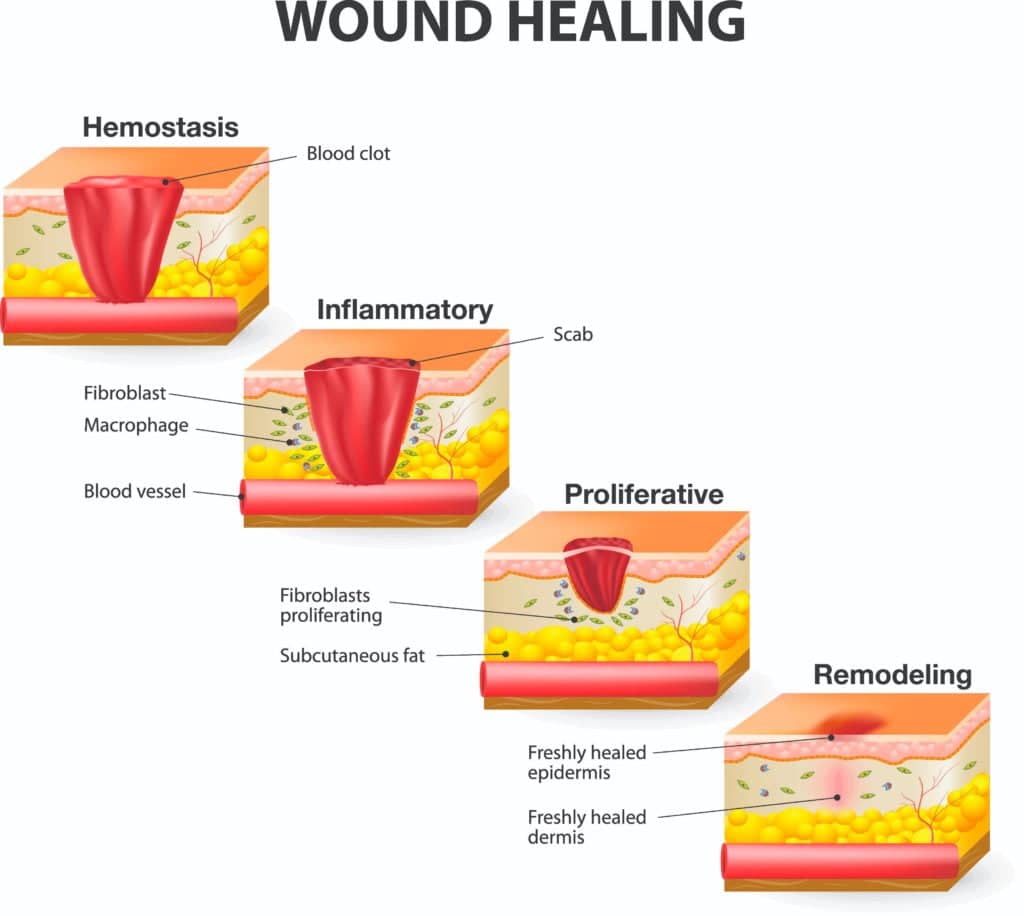 wound-healing-phases-1024x916-1